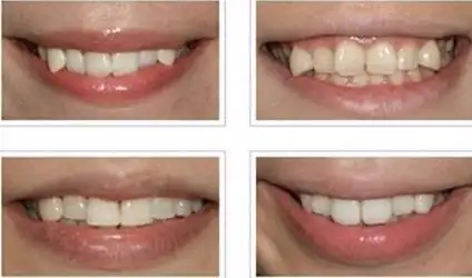 昆山虎牙要怎么矫正