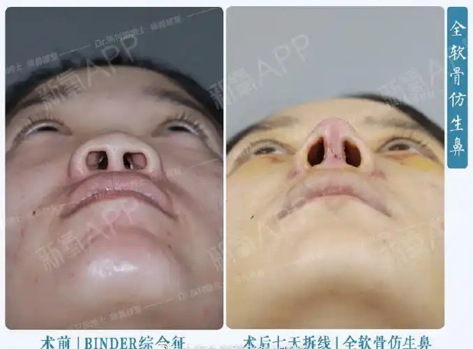 [:13]"binder综合症"又称先天性中面部凹_圈子-新氧美容整形