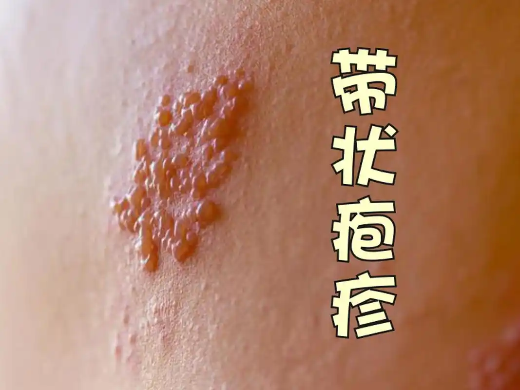 带状疱疹就是老百姓常说的"蛇缠腰","缠腰丹",是由水痘-带状疱疹捕揪