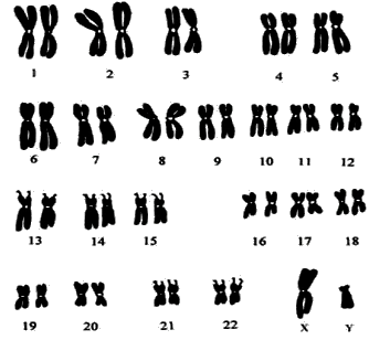 染色体分组诊断与鉴别诊断1.诊断染色体核型分析确诊.