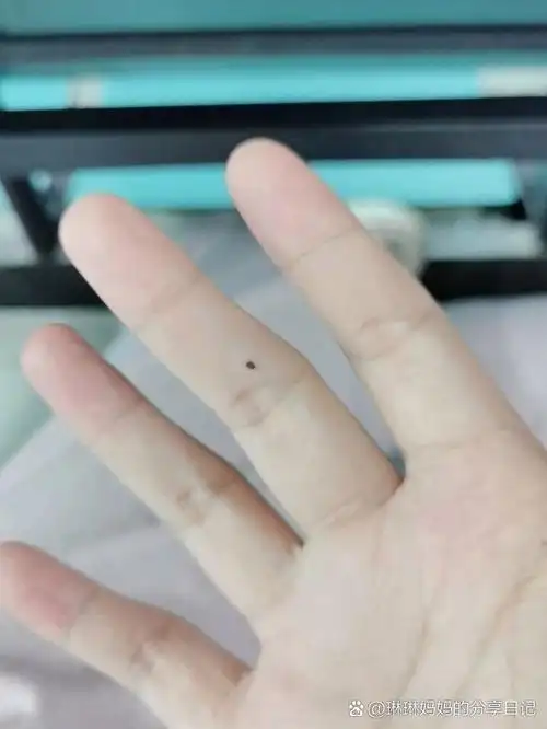 手指长了一个好黑的痣