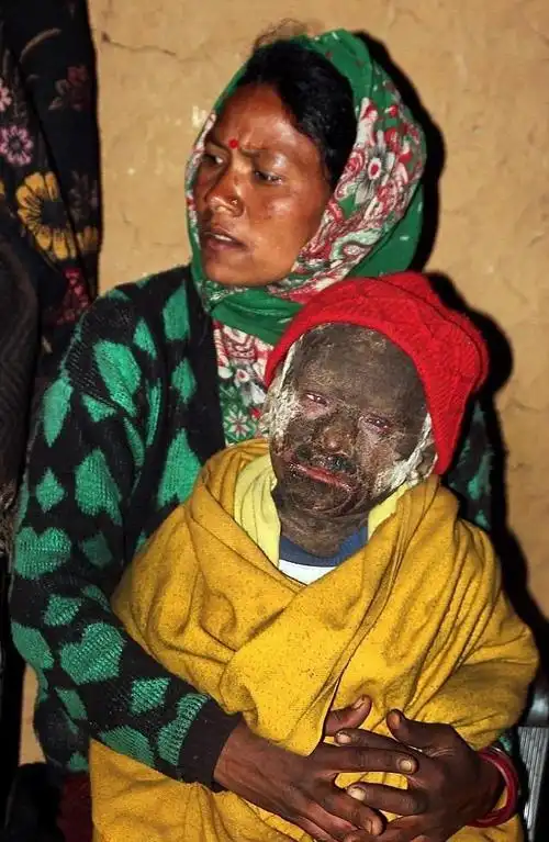 身患鱼鳞藓的印度男孩身上皮肤越来越硬,看后让人辛酸不已