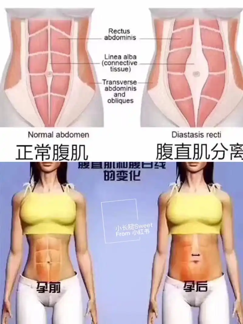 干货99产后修复腹直肌,自测腹直肌分离超简单接地气版!99