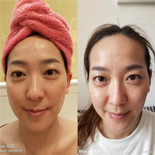 > 面部微雕半侧前后 >