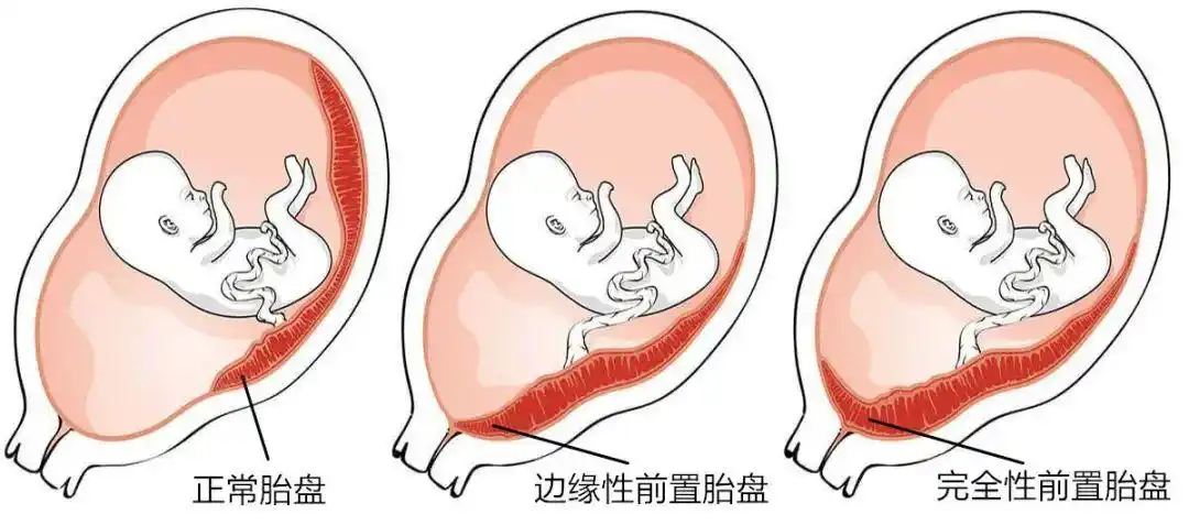【妇产科小张上线啦】暗藏凶险的"前置胎盘"