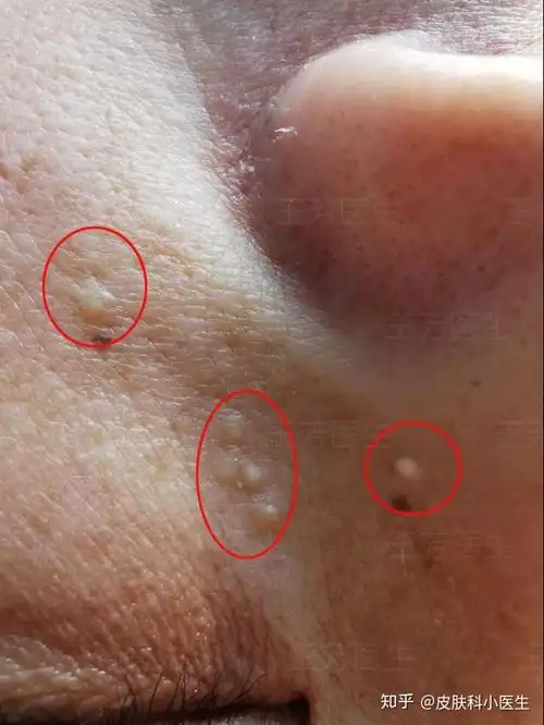 粟丘疹案例