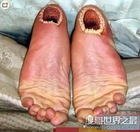 本篇文章图片过于恶心,如果你还想继续往下面看,请最好是有3天不吃饭