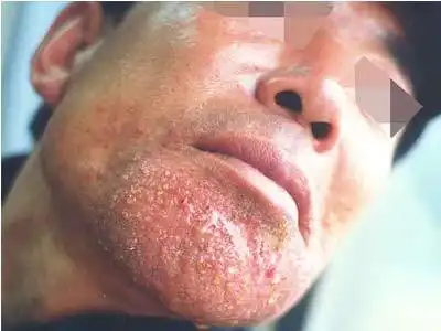 面部湿疹症状图片