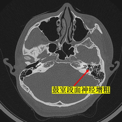 面神经瘤的影像学特点