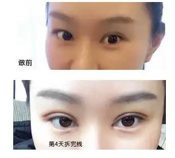 埋线双眼皮 内眼角案例 刘医生技术不错_整容日记_整形前后对比照