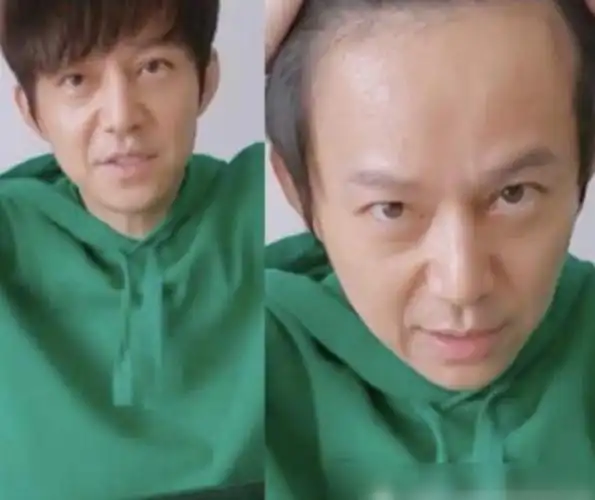 有种差距叫明星掀刘海:沈梦辰发际线后移,看到杨幂:不敢相信_手机搜狐