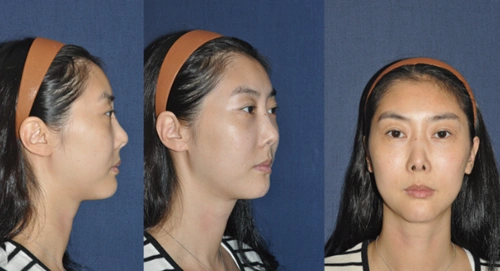 【案例】被判了死刑的鼻子,终于奇迹般的修复成功了