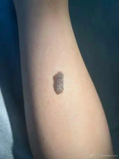 小腿胫前褐色斑块