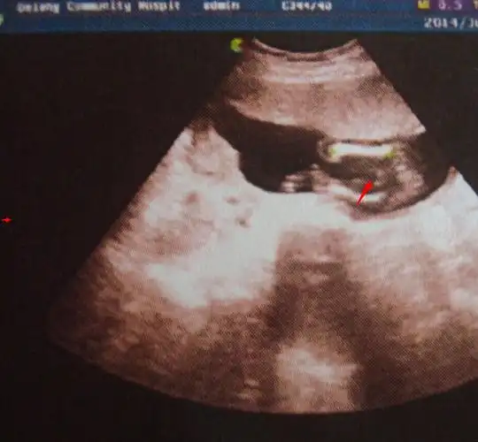 宝妈,看看我这个是男孩女孩啊!感觉是两个亮点,又像是三条线