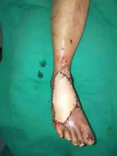 表面损伤外,左脚大拇指也有部分离断,由于来院前的断肢再植成活不理想