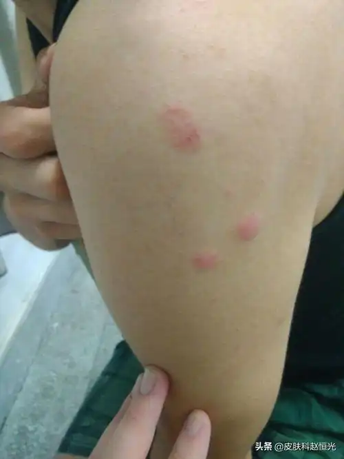 无端起包痒像是蚊子咬的,晚上特别痒,白天不痒(身上突然出现很多红包)