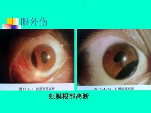 引起儿童眼外伤的原因及护理办法