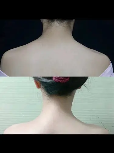 斜方肌严重的,瘦肩针真的很值得打!