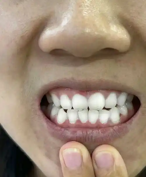 看看过来人怎么说!牙黄朋友快码住!_牙齿_效果_感觉