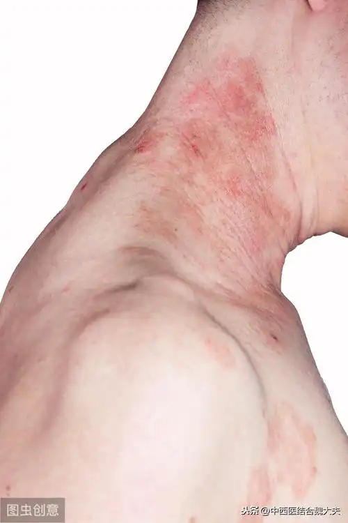 日光性皮炎怎么办如何治疗(皮肤被太阳照射皮肤就过敏,日光性皮炎怎么