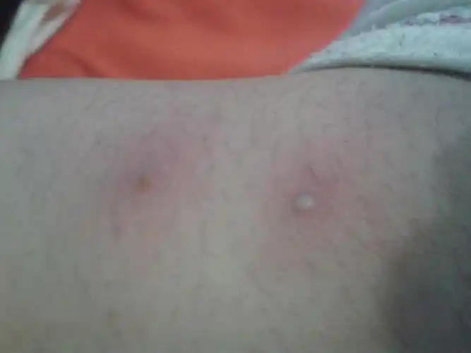 我的腿部有一片皮肤发红,上面有小小水泡还有尖尖的