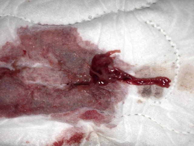 痛经,今天姨妈来了有血肉,嫌恶心的勿进