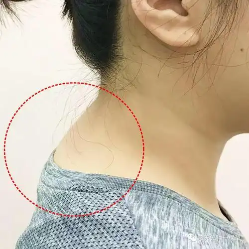 ▼长期不良站姿,坐姿造成的体态问题,像圆肩,脖子前倾,驼背也会导致