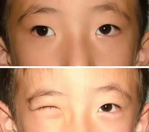 其它 6岁前,这5种"眼病"最易被忽视,错过最佳治疗期 √  外斜视