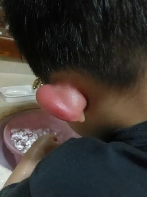 儿子耳廓突然肿起来了,什么情况啊?