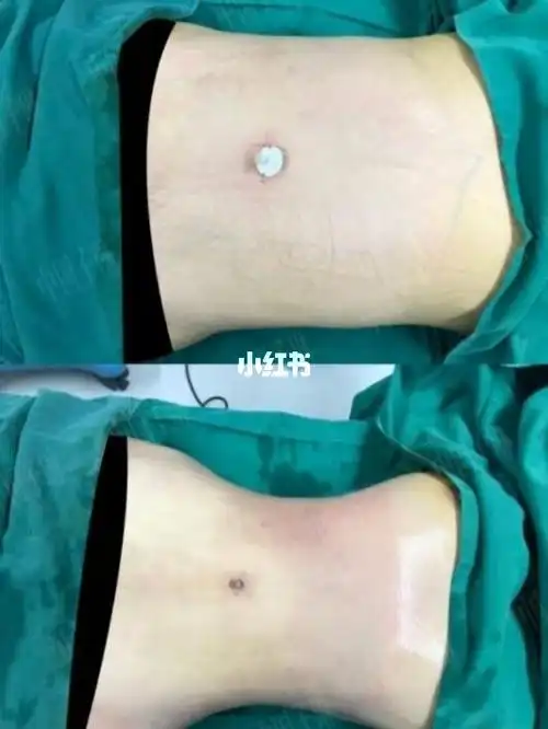 威塑腰腹环吸即刻效果_腰腹_环吸_设计_威塑_减肥_减肥医药