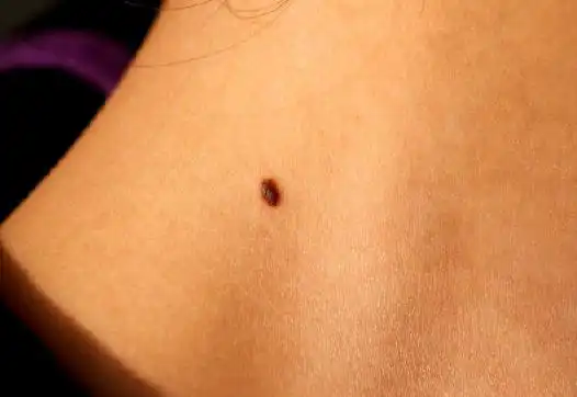 良性黑色素痣图片