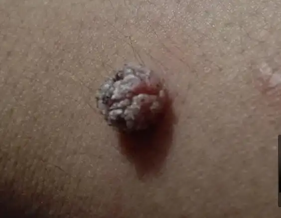 皮肤科的大神请进,手腕上长了一个肉瘤!