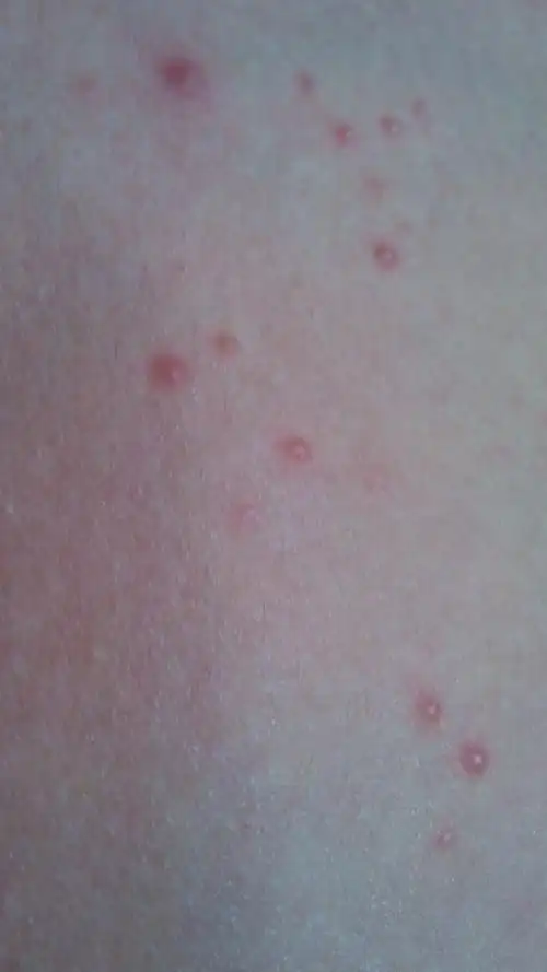 胸前一个月之前有那么一两个的小红点,一开始以为是青春痘,就擦了点