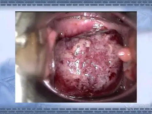 精彩幻灯宫颈癌36个典型病例宫颈图像详解