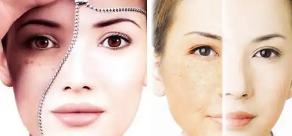 3,光子嫩肤价格与治疗的皮肤范围和皮肤的好坏程度决定,需要操作的