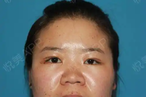 上睑下垂矫正术后12天_全切双眼皮术后12天_眼型矫正术后12天_眼综合