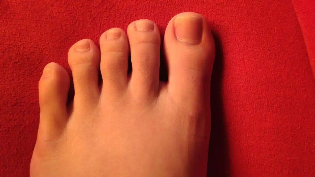 大脚趾一按指甲就疼是怎么回事「大脚趾指甲有一道黑色竖纹」-友友