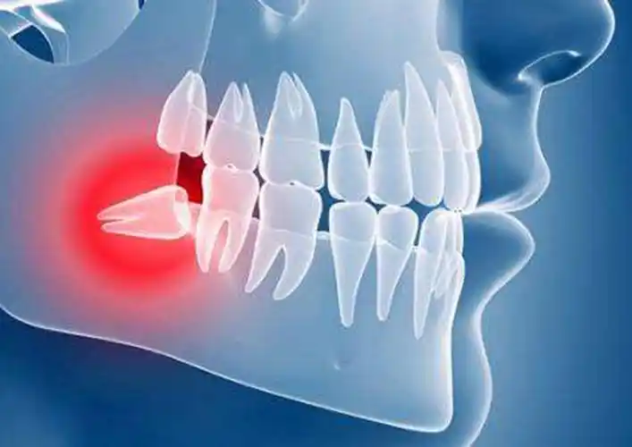 坐标|北京顺义:长智齿了一定要拔掉吗?