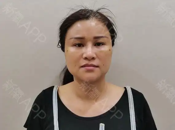 全面部脂肪填充术后的第3天,今天已经恢复正常社交生_圈子-新氧美容