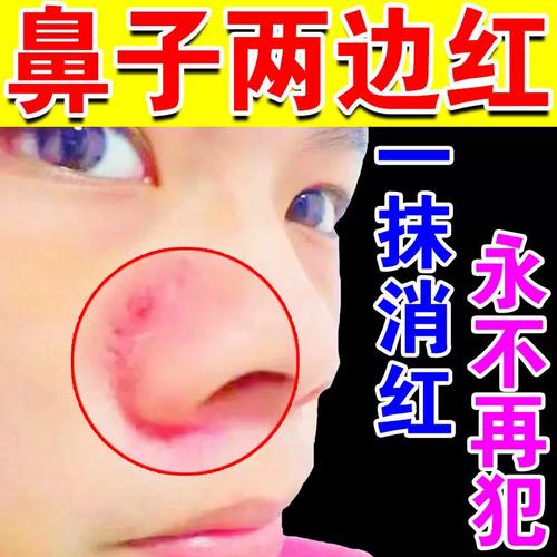 鼻翼两侧泛红毛孔粗大去螨虫治酒糟鼻红鼻子去鼻子红肿修复专用药