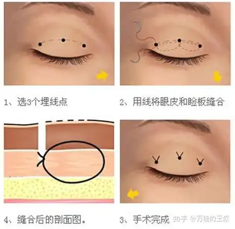 全切双眼皮点式埋线你到底需要什么形态的双眼皮手术和方式