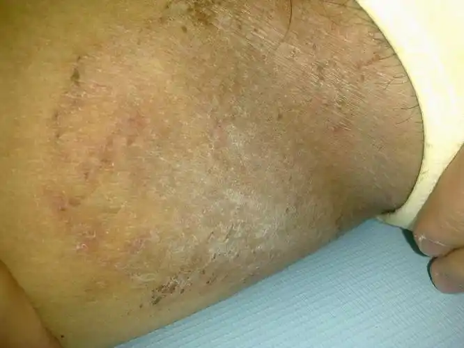 大腿内侧皮肤有问题