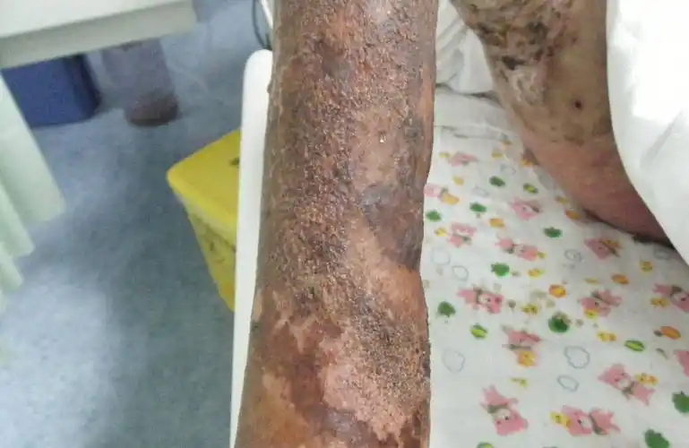 特别严重的放射性皮炎图片