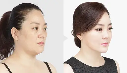 自体脂肪填充可以解决眼部凹陷吗效果怎么样