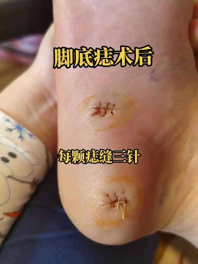 脚底痣术后.每颗痣缝三针,回家后吃五天消炎药,可以去附近医院 - 抖音