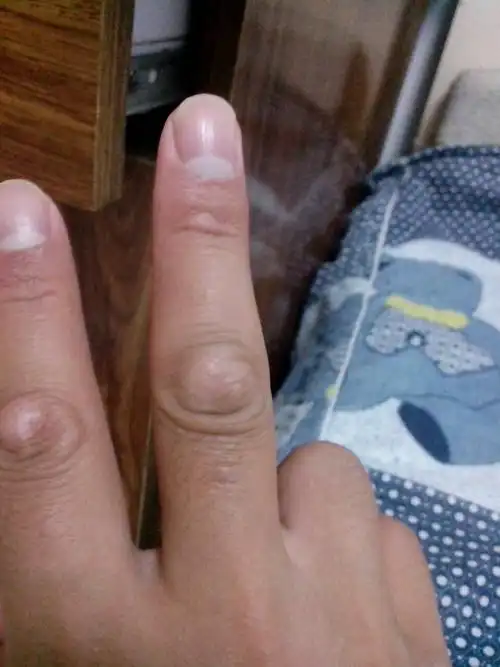 1 2011-01-13 皮肤疼有死皮症状在关节处 1 2010-01-06 手指关节品趑