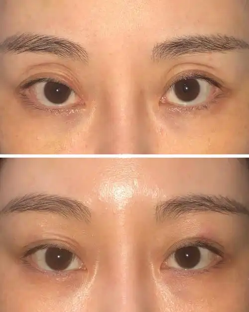 眼窝凹陷解决啦_医美_玻尿酸填充_脂肪填充_变美_化妆_眼窝凹陷_美