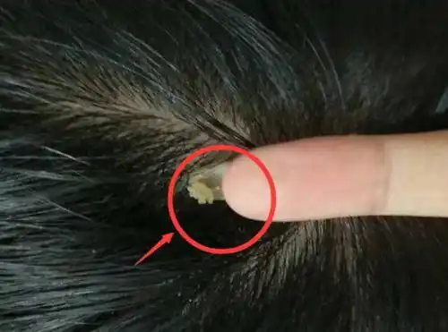 螨虫头上做窝,头皮会出现"白泥",不清理"大油头"找上你!_手机搜狐网
