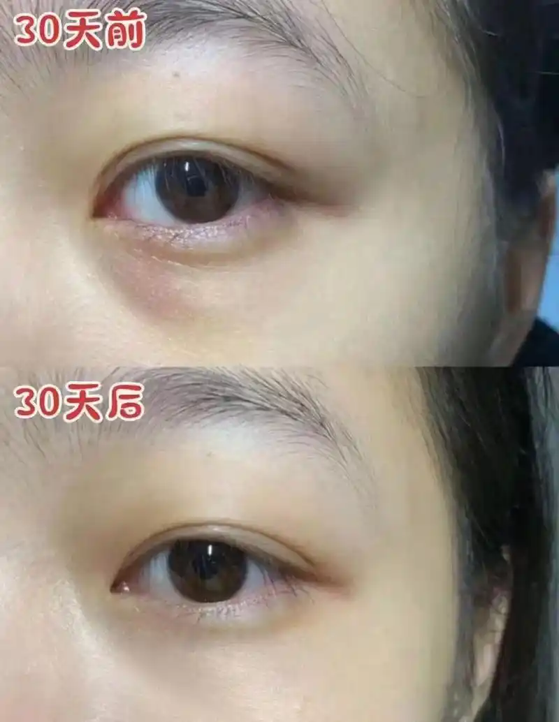 嗨体熊猫针94 去除眼袋,黑眼圈,泪沟 即做即走,无需恢复期 - 抖音