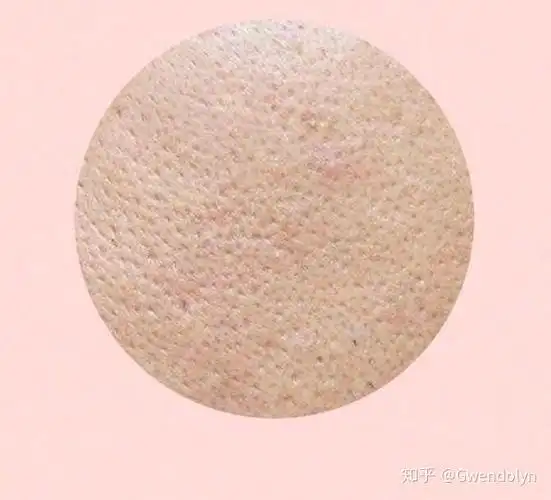 缺水型毛孔粗大